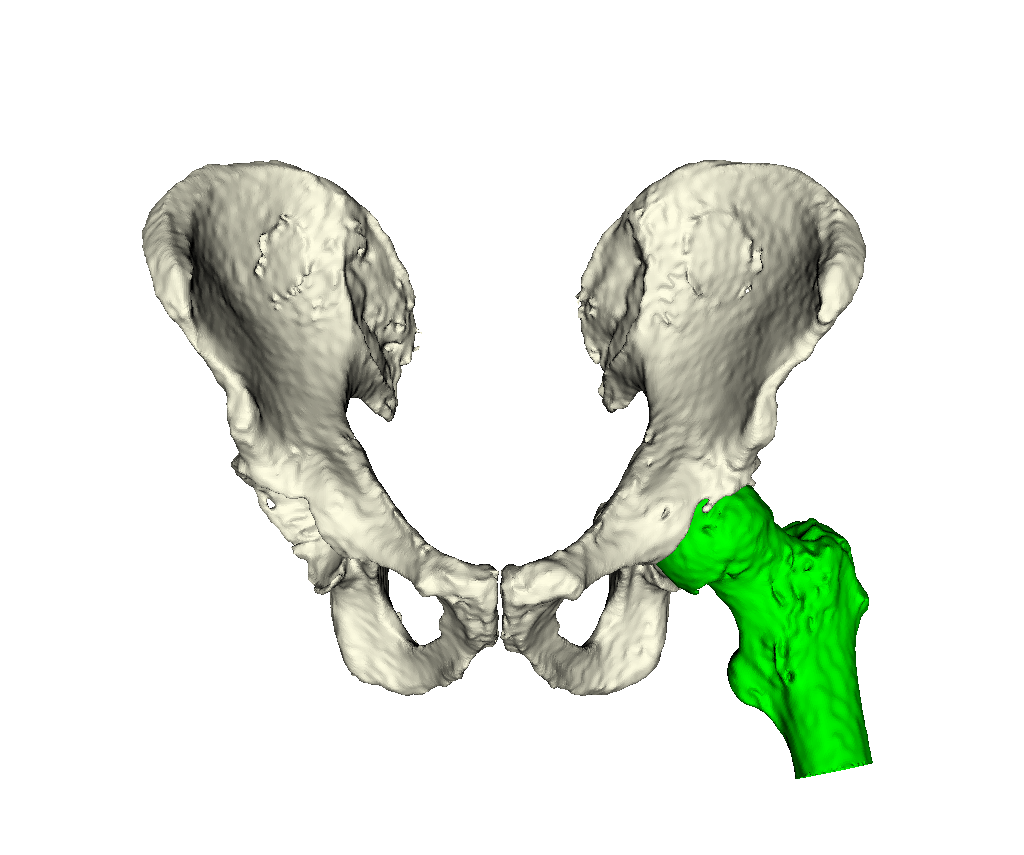 Intraop. Meth. 3 Pelvis and Femurs 3D Viz 1